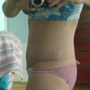 6 weeks post op tummy tuck still swollen