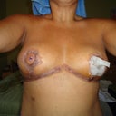 1 Week Post-Op