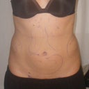 Before (after my pre-op with markups)
