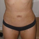 48 hours post-surgery