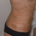 48 hours post-surgery