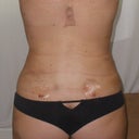 48 hours post-surgery (my favorite pic!)