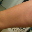 day of treatment, fairly swollen