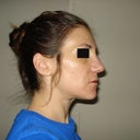 10 days post op. You can see the profile looks nice