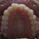 Easier to see the general crookedness of my front teeth.  But as I mentioned, not severe.