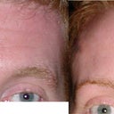 before and after botox