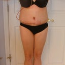 4 Days Post Op