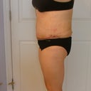 4 Days Post Op