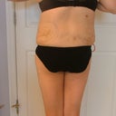 4 Days Post Op