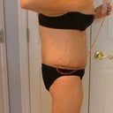 4 Days Post Op