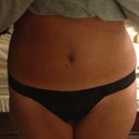 Same evening of lipo (post op.)