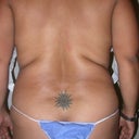 BEFORE BRAZILIAN & LIPO OF BACK