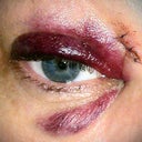 Post tumor removal