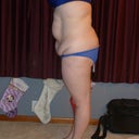 First side 3 days before surgery