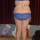 Back side 3 days beofore surgery