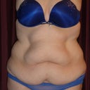 Front side 3 days before surgery