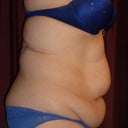 Other side 3 days before surgery