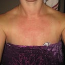 Rash from antiseptic cleaner used during surgery