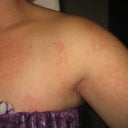 Rash from antiseptic cleaner used during surgery
