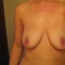 3 weeks post-op
