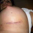 Left  breast suture