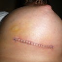 Right Breast Suture