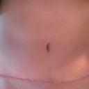12 weeks post op