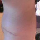 12 weeks post op
