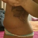 Side view 2 days post op