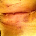 Incision