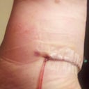 6 days post op