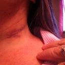 Using both arnica gel and vitamin k cream and I am seeing these bruises improve nicely!