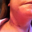 I am swollen but I love that jowel-less jaw line!