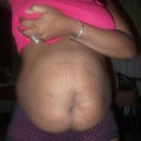 front view of my stomach before tummy tuck