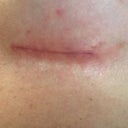 Incision on day 13, they both look the same, skin is irritated because of the sterile strips I had.