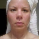 Morning of Day 2. My face is fresh, swelling has gone down, and I look brighter.