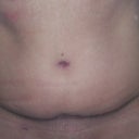 2 1/2 months post op