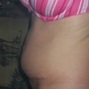 2 1/2 months post op