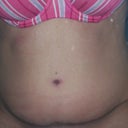 2 1/2 months post op