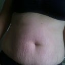 Pre-op picture