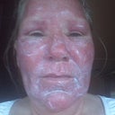 72hours after, still swollen, covered with lotion