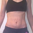 Pre-op (not flexing) Lots of loose skin.  Looked much worse in real life than in this pic