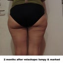 2  Months post: lumpy and full of tracks