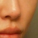 1 month after perlane in bridge, 2 months after perlane in lip border but also had perlane and juvederm combo 3 days ago in nasal folds and juvederm in lips to plump up volume