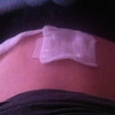 Still bandaged