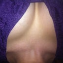 3 weeks post op. they are softening but still need to drop.