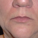 Before Juvederm Ultra