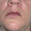 After Juvederm Ultra (3 hours)