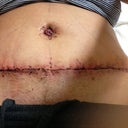 3 days post op, after staples and drains came out