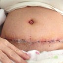 5 days post op